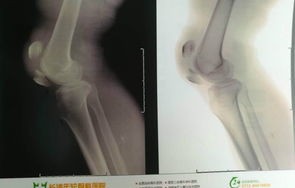 机器人力量惊人，两小伙掰手腕当场骨折