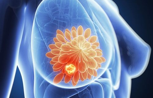 姐妹情深，女子陪妹妹复查乳腺，意外发现自身癌症