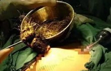 惊险一幕，9岁女孩胃中惊现直径4厘米头发团