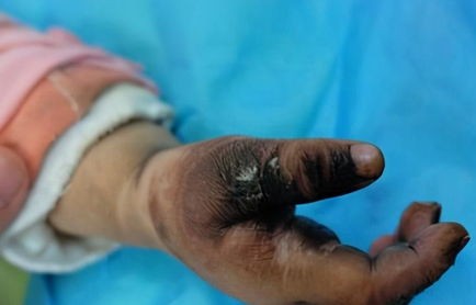 悲剧的瞬间，男孩误用药物后全身溃烂