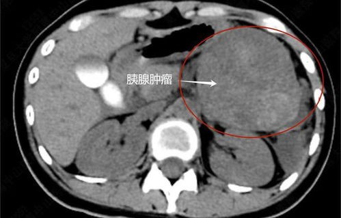 女子肿瘤复发三次，腹部积液近百斤，坚韧生命与抗争的故事