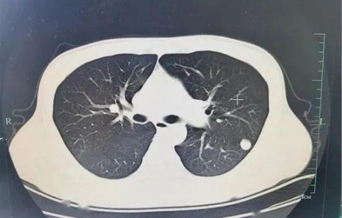 小伙腹泻两周，竟查出感染鬼脸虫