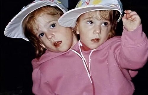 美国双头姐妹宣布怀孕，罕见现象引发热议