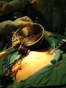 惊险一幕，9岁女孩胃中惊现直径4厘米头发团