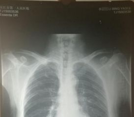 从正常到癌症，女子体检的惊变