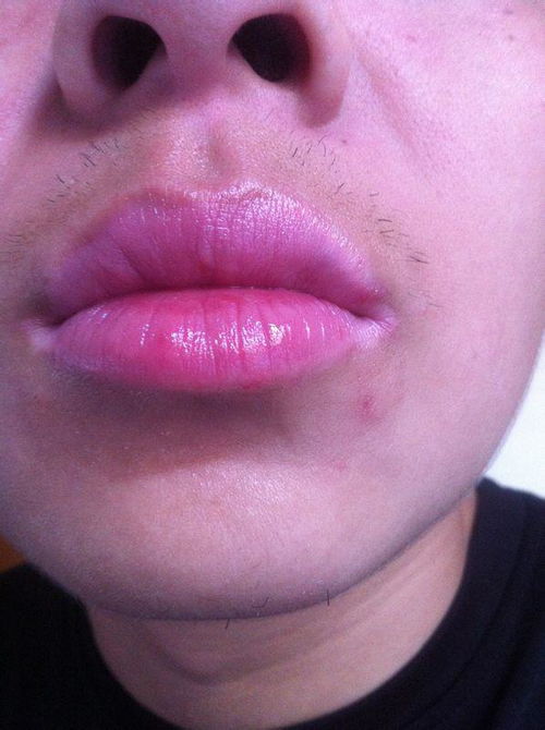 嘴角起泡,一种常见的病毒感染现象 嘴角起泡,一种常见的病毒感染现象