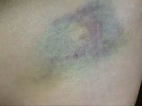 身体莫名淤青，原因与解析