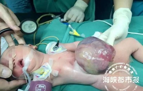 新生奇迹,出生仅两天的宝宝遭遇烫伤,重获新生皮肤