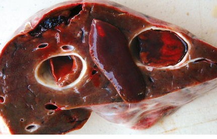 惊现七条虫,男子生食胆道之谜