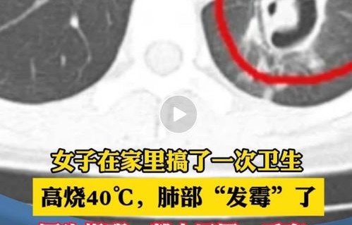 女子硬扛高烧三日，警惕白肺风险